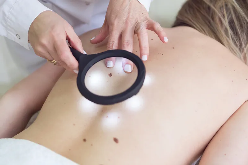 What You Should Know and Understand About Skin Cancer 